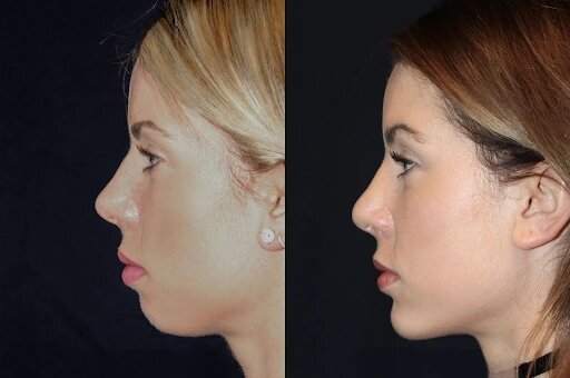 Restore Balance with Chin Fillers Treatments in Dubai