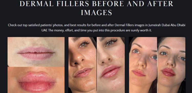 Fillers Treatments in Dubai: Say Goodbye to Fine Lines and Wrinkles