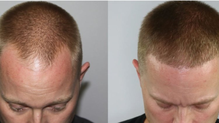 Famous Hair Transplant Result:What to Expect After Treatment