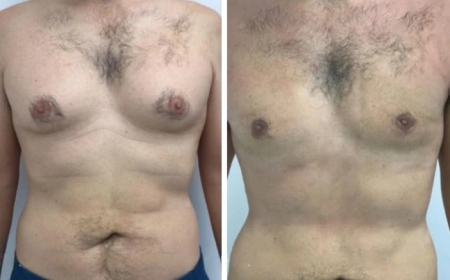 Can Diet and Exercise Reduce Gynecomastia in Dubai?