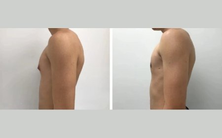 5 Reasons to Consider Gynecomastia Surgery with the Best Surgeons in Dubai