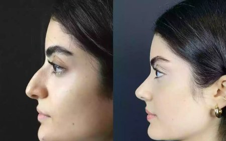 Want Subtle Changes? Choose the Best Rhinoplasty Surgeons in Dubai