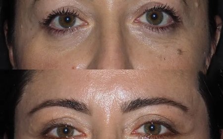How to Avoid Botched Eye Bag Surgeries: Advice from the Best Eye Bag Removal Surgeon in Dubai