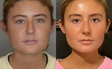 How Long Does Buccal Fat Removal Last? Answers from the Best Buccal Fat Removal Surgeon in Dubai
