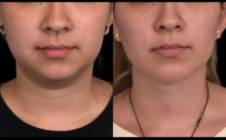What to Do if Double Chin Removal Doesn’t Meet Your Expectations: Insights from the Best Double Chin Removal Surgeon in Dubai