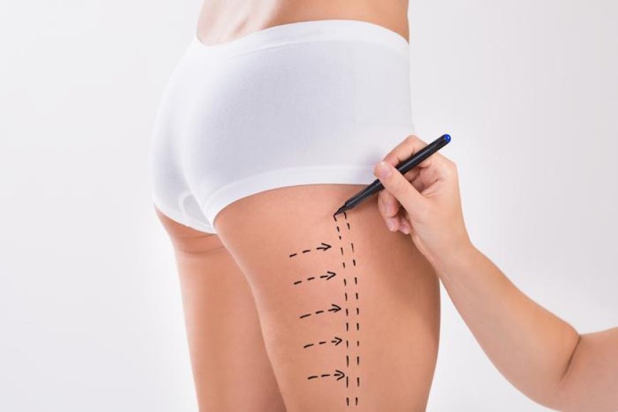 Surgery Recover Right Tips from Best Liposuction Surgeons in Dubai