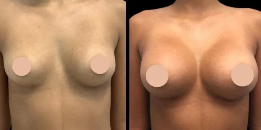 Breast Augmentation in Dubai: Exploring the Recovery Timeline for a Successful Surgery
