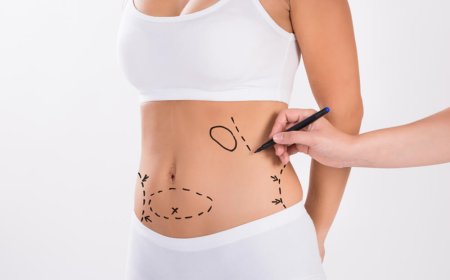 Top Benefits of Choosing 360 Liposuction Dubai for Complete Body Contouring