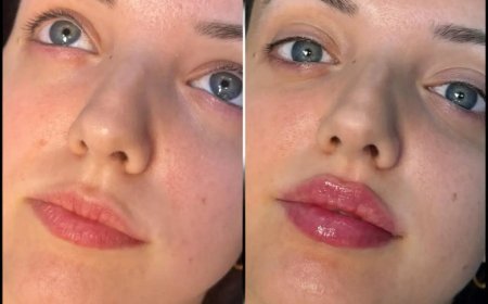 Fillers Treatment in Dubai for Treating Wrinkles with Fillers