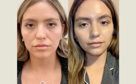 Thread Lift Treatment in Dubai vs. Facelift Surgery: Which Is Right for You