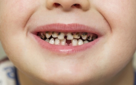 7 Signs of Cavities in Children to Take Note Of!