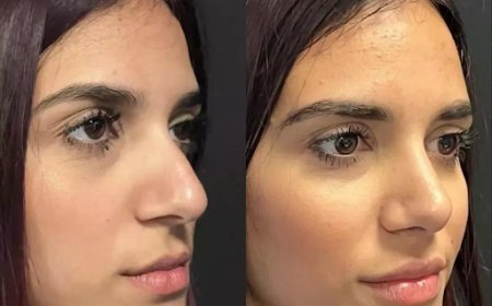 Best Rhinoplasty Surgeon in Dubai for a Natural-Looking Nose