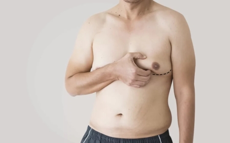 Why Islamabad Gynecomastia Surgery Is Gaining Popularity Among Men