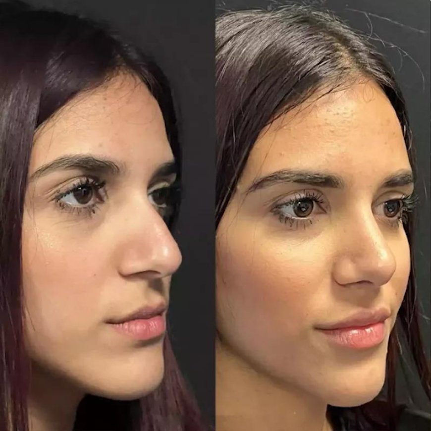 Best Rhinoplasty Surgeon in Dubai for a Natural-Looking Nose